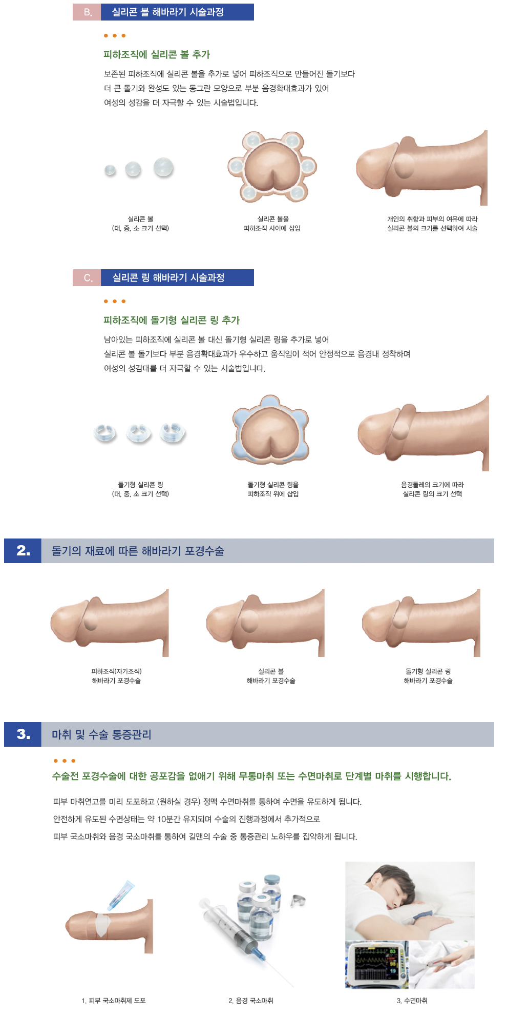 해바라기포경수술